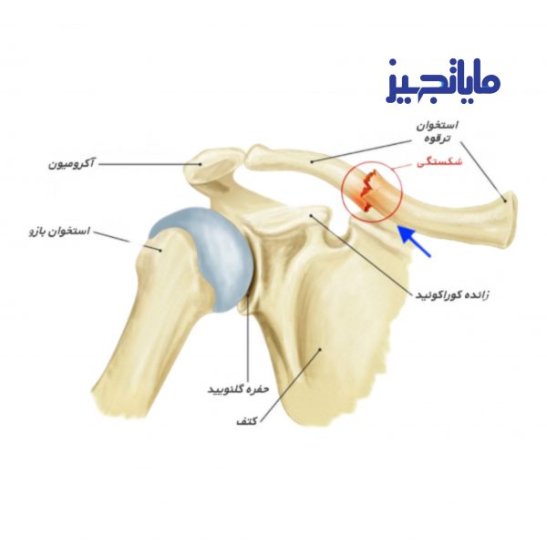 شکستگی ترقوه